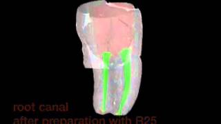 VDW Dental · MicroCTScan of a lower molar clinical video [upl. by Ransell46]