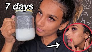 I Used RICE WATER On My Face For One Week  Before And After Results [upl. by Ylurt]