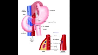 Mystery diagnosis superior mesenteric artery syndrome [upl. by Divad480]