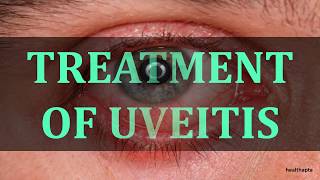 TREATMENT OF UVEITIS [upl. by Marianna]