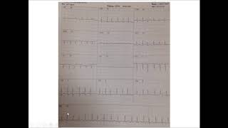 Curso de Taquiarritmias aula VI  Fibrilação atrial parte 2 [upl. by Gimble]