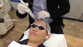 Fotona 4D Laser Skin Tightening Non Surgical Facelift Skin Tightening [upl. by Mell446]