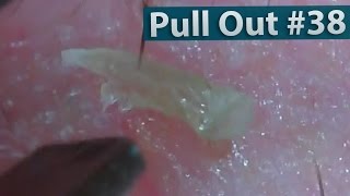 38 Pull Out Blackheads Close up  Blackheads Removal [upl. by Llenil507]