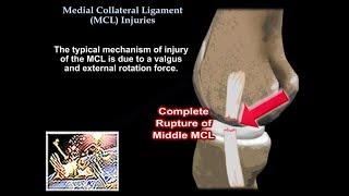 Medial Collateral Ligament Injuries  Everything You Need To Know  Dr Nabil Ebraheim [upl. by Leahcimnaes413]