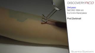 Quanta Discovery Pico Laser tattoo removal Treatment [upl. by Devad]