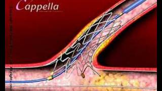 Cardiology heart valve stent3D medical animation produced by Virtual Point [upl. by Favianus]