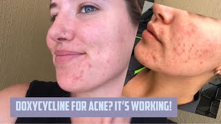 DOXYCYCLINE 412 weeks of treatment Acne update [upl. by Debee319]