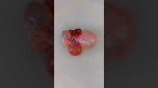 Polycystic ovary grossing video  histopathology uterinefibroid cystitis placentahistology tb [upl. by Thielen]