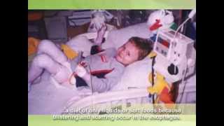 Epidermolysis Bullosa EB Awareness video extended [upl. by Kcirdneh]