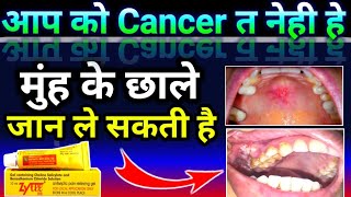 Zytee Rb Gel uses In Hindi  Zytee rb gel  मुंह के चाले की बेस्ट जेल  Doses  Uses  Sideeffect [upl. by Htiek880]