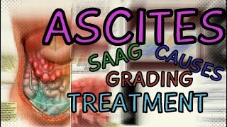 What are Ascites Transudate vs Exudate  SAAG  Fluid Wave Test  Shifting Dullness  Treatment [upl. by Rebeka]