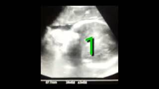 BOTH FEMALES GENDER AND CEPHALIC l TWIN PREGNANCY l 🔥🔥🔥 1 baby doctor ultrasound pregnancy [upl. by Leggett]