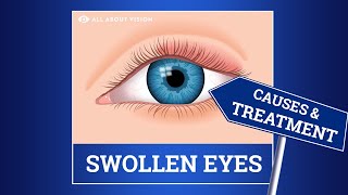 Swollen Eyelid Causes amp Treatment [upl. by Kilar]