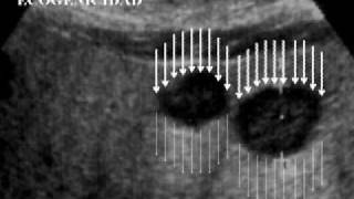 01 Ecografía Hepatobiliopancreática Fundamentos Básicos [upl. by Alleiram125]