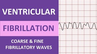 Ventricular Fibrillation VFib ECG Interpretation Nursing Heart Rhythms NCLEX ACLS [upl. by Salvador]