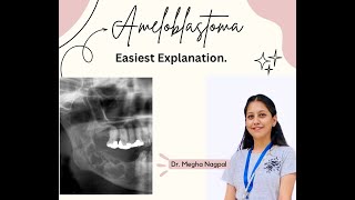 Ameloblastoma01  Easiest Explanation  Oral Pathology  BDS [upl. by Rad110]