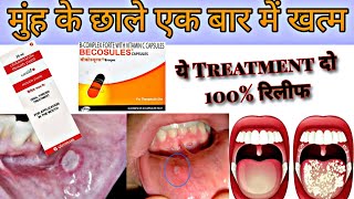 मुंह के छाले का 100 ईलाज Mouth Ulcer Treatment  कोई डॉक्टर नही बताएगा ये ईलाज  mouthulcer [upl. by Nosimaj449]