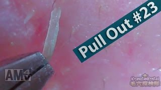 23 Pull Out Blackheads Close up  Blackheads Removal [upl. by Gabriele]