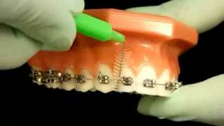 Bracesquestionscom  Brushing With Braces How to Brush Teeth [upl. by Neelhsa]