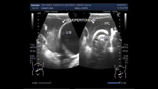 Hemoperitoneum due to Blunt trauma in a traffic accident [upl. by Elram]