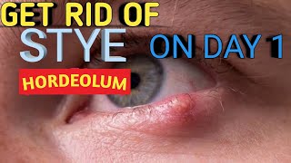 Stye removal at home  Chalazion draining  Chalazion treatment  stye eye pop  hordeolum treatment [upl. by Bevash]