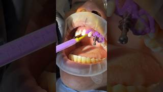 Open Tray Impression with Panasil XLight and Tray Soft Heavy kettenbachusa dentist impression [upl. by Anaynek78]