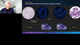 How to Improve HER2 testing Accuracy Incorporating the 2018 ASCOCAP Focused Update [upl. by Asp]