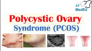 Polycystic Ovary Syndrome PCOS  Causes Risks and Treatments [upl. by Young]