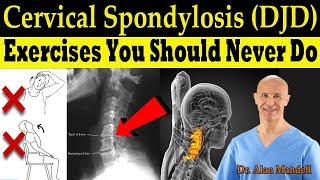 Cervical Spondylosis DJD Exercises You Should Never Do Correct Exercises  Dr Alan Mandell DC [upl. by Idnir]