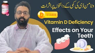 Vitamin D Deficiency Effects On Your Teeth  ateeqdentalcare  URDU HINDI [upl. by Minni]