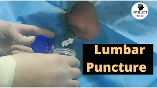 Lumbar Puncture Procedure in just 11 mins [upl. by Madea]