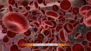 Behind the Mystery Polycythemia Vera [upl. by Atteras]