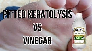 Easy way to cure pitted keratolysis cara menyembukan kaki rayapan [upl. by Name500]