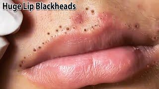 Removes a lot of blackheads on upper and lower lips  Satisfaction and Relaxation Videos 2024  Tips [upl. by Zosima820]