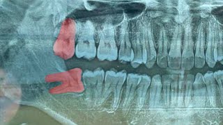 Removal Of 2 Wisdom Teeth At Once  Odontectomy  Geraham Bungsu  Dentist  Dokter Gigi Tri Putra [upl. by Htbazile]