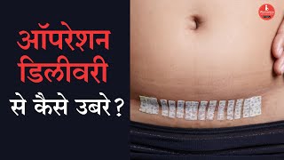 सिजेरियन डिलीवरी के बाद अपना ख्याल कैसे रखे Cesarean delivery recovery in Hindi [upl. by Okimuk]