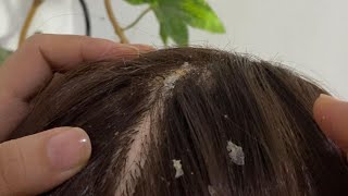 ASMR  Dandruff Removal amp Scalp Check Extremely Satisfying [upl. by Agosto799]