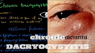 Chronic Dacryocystitis  lacrimal system [upl. by Adnilrem]