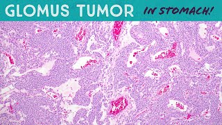 Glomus Tumor in STOMACHsoft tissue pathology gastricgastrointestinal tumor [upl. by Roda]