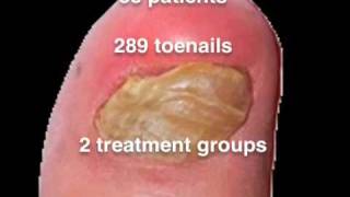 Nail Lacquer Shown Effective for Toenail Fungus [upl. by Pike423]