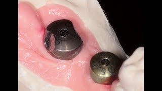 Healing Abutment is Stuck [upl. by Adnahsed]