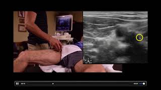 Deep Vein Thrombosis  Diagnosis with Ultrasound [upl. by Brigida]