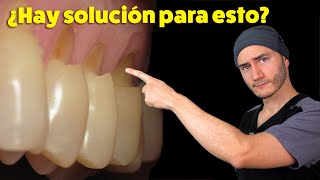 Desgastes en el cuello de los dientes  Causa y Solución  Abfracción Dental [upl. by Ati]