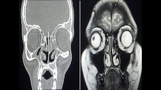 Understanding MRI What is functional MRI fMRI [upl. by Ciaphus334]