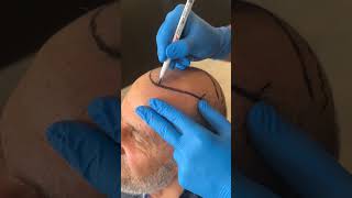 Hair Transplant in Turkey  Hair Transplant Process hairtransplant [upl. by Adonis66]