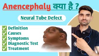 Anencephaly in Hindi  Causes Symptoms And Treatment of Anencephaly [upl. by Ttehc665]