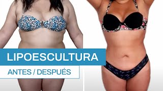 ¿Cómo es una Lipoescultura Antes y después  Clínica Barrenechea [upl. by Breeze]