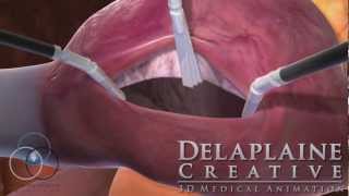 Robotic Atrial Septal Defect Repair [upl. by Kidder829]