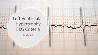 Left Ventricular Hypertrophy  EKG Criteria Sokolow  Lyon amp Cornell [upl. by Hpeosj854]