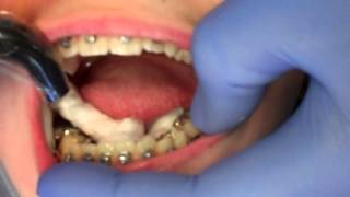 Hebst appliance  Athanasios Nasiopoulos Orthodontist Thessaloniki  Edinburgh [upl. by Dardani]